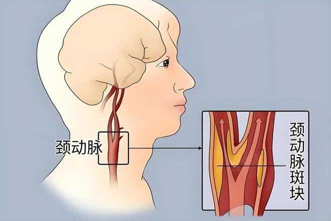 从颈动脉斑块70%狭窄到指标正常：燕麦β-葡聚糖的代谢调控机制深度解析